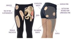 Bursitis Hip Relief, Greater Trochanteric Pain Syndrome, Hip Injury, Medical Tips, Hip Injuries, Gluteal Muscles, Hip Surgery