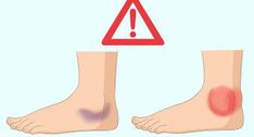 How to Treat a Torn Calf Muscle: 14 Steps (with Pictures) Ankle Sprain Recovery, Torn Calf Muscle, Soleus Muscle, Gastrocnemius Muscle, Hairline Fracture, Ankle Sprain, Medical Tips, Warm Compress, Bone Fracture