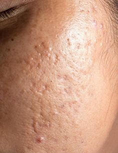 Acne Texture, Aging Aesthetic, Acne Aesthetic, Skin Aesthetic, Mises En Page Design Graphique, Skin Care Pictures, Acne Scarring, Skincare Branding, Skin Aesthetics