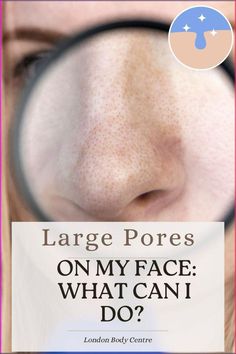 Large pores on the face are a common concern for many individuals, impacting their confidence and overall appearance. Pores are essential for skin health, as they allow the skin to breathe and release toxins. However, when pores become enlarged, they can be more noticeable and prone to clogging, leading to skin issues like acne and blackheads.

This guide aims to provide an in-depth understanding of what causes large pores and explore the latest aesthetic and cosmetic treatments available to minimize their appearance. Whether you're a skincare enthusiast, a professional in aesthetics, or someone exploring treatment options, this comprehensive guide will equip you with the knowledge needed to address large pores effectively. Large Pores On Face, Large Pores On Nose, Open Pores On Face, Fat Dissolving Injections, Pores On Face, Soothing Face Mask, Nose Pores, Reduce Pores, Face Aesthetic