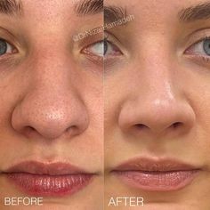 Face Procedures, Nose Jobs, Facial Fillers, Nose Job, Fat Removal, Plastic Surgery