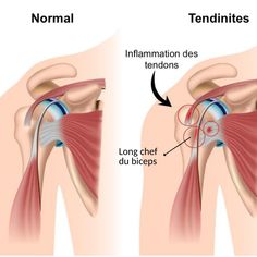 an image of the shoulder and tenditions