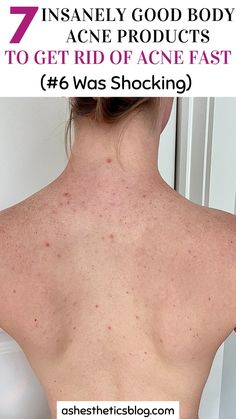 These body acne products and tips cleared my acne in less than a month I was so shocked. This post was insanely helpful I'm so happy I found it!! Body Acne Map, Body Acne Products, Body Acne Remedies, Get Rid Of Body Acne, Acne Hacks, Acne Routine, Acne Body Wash, Natural Hair Care Routine, Acne Hyperpigmentation