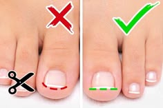 Cut Nails, Ingrown Nail, How To Cut Nails, Ingrown Toe Nail, Nail Fungus, Pastel Nails, Gel Nail Designs, Manicure Y Pedicure, Nail Shapes