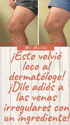 ¡Esto volvió loco al dermatólogo! ¡Dile adiós a las venas irregulares con un ingrediente! Natural Beauty Remedies, Air Fryer Dinner Recipes, Beauty Remedies, Body Skin Care Routine, Healthy Breakfast Recipes, Health Diet, Body Skin, Body Skin Care, Natural Remedies