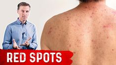 Dr Burg, Red Skin Spots, Red Moles, Dr Eric Berg, Health And Wellness Center, Eric Berg, Dr Berg, Doctor Advice, Diet Doctor