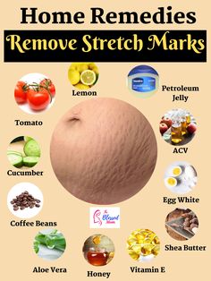 home remedies to remove stretch marks Strech Marks Remedies, Strech Marks, Stretch Mark Remedies, Stretch Mark Cream, Stretch Mark Removal, Boys Boxers, Beauty Remedies