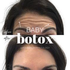 We provide BOTOX® Cosmetic treatments for the reduction of wrinkles and fine lines. Schedule an appointment in McLean or Potomac. Forehead Botox Units, Baby Botox Before And After, Before And After Botox Pictures, Botox Before After, Botox Forehead, Botox Results, Facial Aesthetic, Disney Eyes