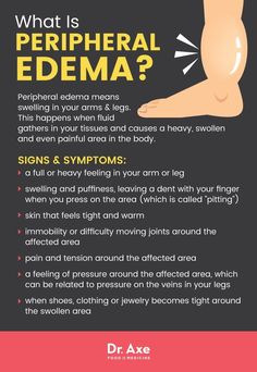 Edema Causes, Heal Cavities, Swollen Legs, Natural Therapy, Health Matters, Natural Treatments, Natural Healing