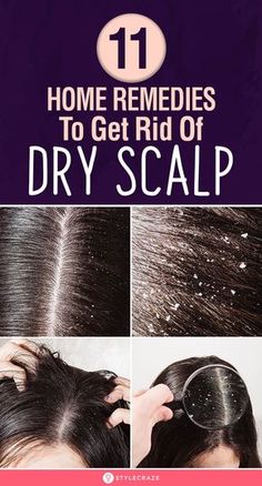 Remedies For Dry Scalp, Scalp Moisturizer