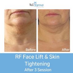 Radio Frequency (RF) helps lift and tighten the skin to achieve a more youthful appearance 😆⁠ A few benefits of RF are:⠀⁠ ✅ Helps reduce/remove Cellulite⁠ ✅ Reduces localised areas of Fat⠀⁠ ✅Reduce fine lines and wrinkles ⁠ ✅ Tightens Skin⠀ ⁠ ✅ Contours Body Area(s)⁠ ⠀ ⁠ What areas can be Targeted:⁠ 🎯 Arms⠀ ⁠ 🎯 Abdomen⠀⁠ 🎯 Love Handles⠀⁠ 🎯 Bum⠀⁠ 🎯 Face⁠ ⁠ Tlc Group, Cosmetic Injections, Radio Frequency Skin Tightening, Tighten Facial Skin, Best Laser Hair Removal, Laser Clinic, Dermatologist Recommended Skincare, Cosmetic Injectables, Remove Belly Fat