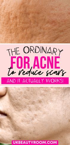 7 Best Products from The Ordinary for Acne Scars Ordinary Skincare, Skin Diet, Skin Natural Remedies