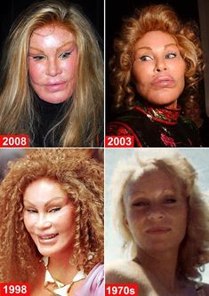 #plasticsurgery #plasticsurgerygonewrong #beforeafter #celebritiesbeforeafter #hollywoodstars #bignosesurgery #surgery #facesurgery #vlinesurgery #koreanplasticsurgery #kpopplasticsurgery #nosejob #jawreductionsurgery #eyesurgery #cheekfillers #rhinoplasty #facelift #plasticsurgeryfails #expensiveplasticsurgery Scariest Picture, Bad Celebrity Plastic Surgery, Botched Plastic Surgery, Bad Plastic Surgeries, Plastic Surgery Procedures, Kate Jackson