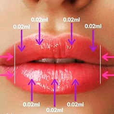 Botox Lips, Hyaluronic Acid Fillers