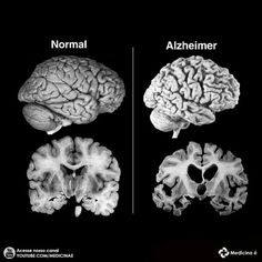 three different views of the human brain, one showing normal and another with alchelimer