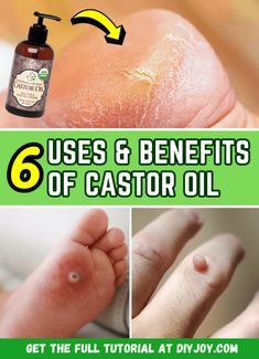 6 Surprising Uses & Benefits Of Castor Oil Castor Oil For Hemmoroids, Benefits Of Castor Oil, Castrol Oil, Castor Oil Packs