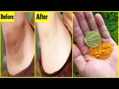 Removing Dark Armpits, How To Whiten Underarms, Armpit Whitening, Underarm Whitening Cream, Natural Remedies For Migraines, Dark Armpits, Underarm Odor, Male Fitness, Dry Skin Remedies