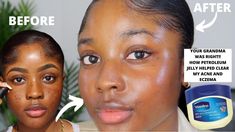 Hey friends! Welcome back to my CHANNEL! How have you all been? I’m back with another skincare video as I can tell that you guys have been enjoying them A LO... Vaseline Uses For Face, Vaseline For Face, Vaseline Beauty Tips, Cabello Afro Natural, Vaseline Jelly, Face Acne, Acne Remedies, Skincare Video