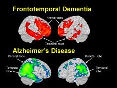 Frontotemporal Dementia (FTD) vs Alzheimer's Disease Alzheimer Care, Alzheimers Awareness, Unhealthy Diet, Low Carb Diets, Senior Health, Leaky Gut, Elderly Care