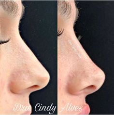 Nose Plastic Surgery, Nose Surgery Rhinoplasty, Nose Fillers, Rhinoplasty Nose Jobs, Botox Lips, Facial Surgery, Pretty Nose, Cheek Fillers, Facial Fillers