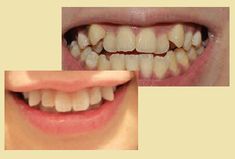 before and after photos of teeth with porcelain veneers