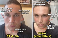 I Had A Celebrity Dermatologist Use Fillers To Sculpt My Face And This Is What Happened, How Much It Would Cost, And Everything You Need To Know Jawline Filler, Juvederm Voluma, Strong Jawline, Facial Contouring, Everyday Workout, Dermal Fillers, Lip Fillers, Double Chin