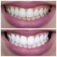 Natural Teeth Whitener, At Home Teeth Whitening, Teeth Whiting At Home, Home Teeth Whitening, French Beauty Secrets, Teeth Whitener, Teeth Whitening Diy, Teeth Whitening Pen