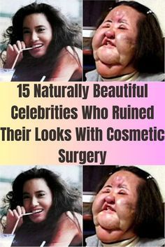 Celebrity Street Style 2023, Bad Celebrity Plastic Surgery, Celebrity Surgery, Bad Plastic Surgeries, Dark Beauty Fashion, Facial Plastic Surgery, Celebrity Plastic Surgery