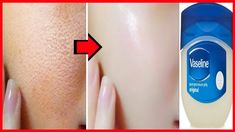 How To Get Rid Of Discoloration On Face Vaseline For Face, Vaseline Original, Vaseline Uses, Vaseline Beauty Tips, Beauty Hacks Lips, Petroleum Jelly, Beauty Tricks, Unwanted Hair Removal, Natural Beauty Tips