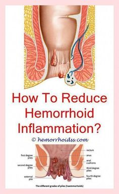 Hemorrhoid Removal, Liver Food, Thrombosed Hemorrhoid, Wound Care Nursing, Plantar Warts, Ear Reflexology, Remedies For Inflammation, Natural Pain Killers