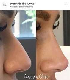 Nose Job Inspo Natural, Beautiful Noses Woman, Straight Nose Aesthetic, Rhinoplasty Front View, Ideal Nose Rhinoplasty, Liquid Rhinoplasty Before And After, Nose Job Inspiration Natural, Straight Nose Side Profile, Ultrasonic Rhinoplasty