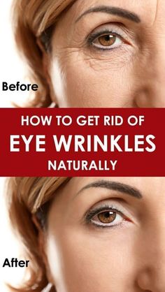 This revolutionary skin rejuvenating method is also backed by science, with more and more prestigious universities such as Harvard and Stanford vowing for its amazing results. Deep Forehead Wrinkles, Remove Eye Wrinkles, Wrinkles On Face, Get Rid Of Wrinkles, Eye Wrinkles