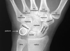 an x - ray shows the bones of the hand and wrist, with labeled carpulations