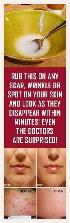 Eliminate Wrinkles, Beauty Remedies, Skin Care Acne, Beauty Treatments, Skin Problems, Facial Skin, Skin Treatments