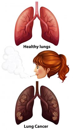 Women smoking with healthy and cancer lungs Free Vector Character Collage, Red Gradient Background, Healthy Heart Tips, Lung Health, Health Images, Healthy Lungs, Cell Line, Lungs Health