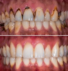 Tooth Caries, Aesthetic Dental, Medical Items, Teeth Whitening Methods, Cosmetic Dentistry Procedures, I Healed, Dental Images