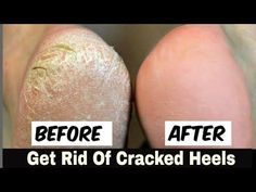 Cracked Feet Remedies, Cracked Heel Remedies, Baking Soda Face Scrub, Overnight Beauty Hacks, Overnight Beauty, Cracked Heels, Nail Fungus, Health Magazine, Belleza Natural