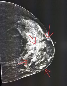 #Mammogram: #benign fatty #tumor (#hamartoma) in the #breast in patient with palpable #lump. #radiologist #radiology Medical Ultrasound, Nursing, Medical