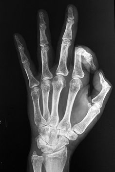 an x - ray image of a hand showing the bones