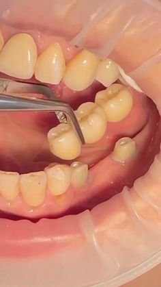 Dentistry blog on Instagram: "Implant supported bridge 🦷 . . By @dr.minigulov #teeth#tooth#toothless#extraction#cirugiabucal#oralsurgery#dental#dentist#dentistry#dentalhygiene#dentalassistant#dentalschool#dentalstudent#dentalhygiene#implant#dentist#odonto#odontogram#odontologo#odontolove#odontología#odontologia#odontogram#odontoporamor#estomatología#prosthesis#prosthodontics#ortho#braces#smile#drawing" Braces Smile, Dentist Marketing, Implant Dentist, Smile Drawing, Dental Braces