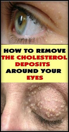 Tips Kesehatan, What Causes High Cholesterol, Cardiac Diet, Eye Problems, Skin Growths, Lower Your Cholesterol, Reduce Cholesterol, High Cholesterol, Lower Cholesterol