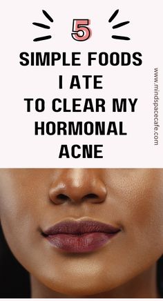 Hormonal acne has been a very serious struggle for me because I have a mixture of cystic acne and chin acne. I have learned that certain foods help get rid of jawline acne and chin acne. Treating cystic acne with these foods will actually help remove treat acne from the inside. Follow this hormonal acne diet by eating these foods. #hormonalacne #acnediet How To Balance Hormones For Acne, Back Acne Routine, Things To Get Rid Of Acne, Best Ways To Get Rid Of Acne, At Home Facial For Acne, Herbs For Acne, Chin Acne Remedies, Hormonal Cystic Acne, Chin Acne Causes