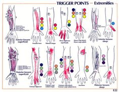 Your "carpal tunnel" pain in the wrist is actually coming from median nerve compression higher up in your arm.  But your surgeon won't tell you that because they do not learn how to treat trigger points like chiropractors do, without scalpels.  :) Punkty Spustowe, Neuromuscular Therapy, Elbow Pain, Trigger Point Therapy, Tennis Elbow