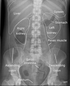 an x - ray shows the ribs and bones