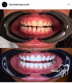 Teeth Aesthetic, Cute Braces, Nice Smile, Braces Colors, Dental Cosmetics, Wrist Tattoos For Women, Perfect Smile, Healthy Smile