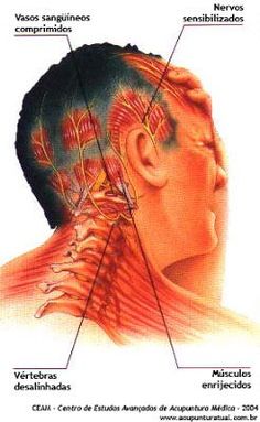 Yoga Poses & Workout : Acupuntura Contemporânea Contemporary Acupuncture Acupuncture Contemporaine: As Cervicogenic Headache, Punkty Spustowe, Occipital Neuralgia, Headache Relief Instant, Natural Remedies For Migraines, Headache Types, Natural Headache Remedies, Migraine Relief, Tension Headache