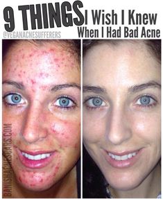 Face Breaking Out, Teenage Acne, Haut Routine, Cystic Acne