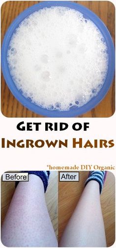 Get rid of ingrown hairs Get Rid Of Ingrown Hairs, Jus Lemon, Ingrown Hair Remedies, Baking Soda Shampoo Recipe, Ingrown Hairs, Baking Soda Shampoo, Body Hacks, Beauty Remedies, Homemade Remedies