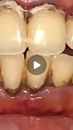 Healthy Tips on Instagram: "Remove Tartar and Yellowness From Your Teeth #teethwhitening #yellowteeth #remedy #naturalremedies" Remove Tartar From Teeth At Home, How To Remove Tartar From Teeth, How To Whiten Teeth At Home, Teeth Whitening Before And After, Yellow Teeth Remedy, Instant White Teeth, White Teeth Tips, Whiten Teeth At Home, Remineralize Teeth