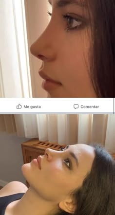 Nose Job Inspiration, Before And After Nose Job, Nose Types, Rhinoplasty Nose Jobs, Rhinoplasty Before And After, Job Inspiration, Pretty Nose, Perfect Nose, Small Nose